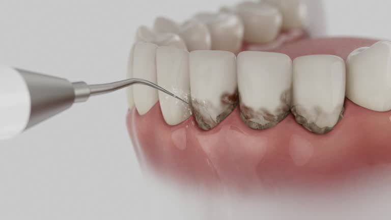 Reliable Dental Implants contractor in Pine Brook, NJ by Smile Center Dentistry